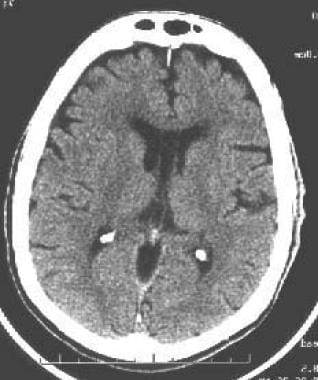 Atrophy of the brain, resulting in a space between