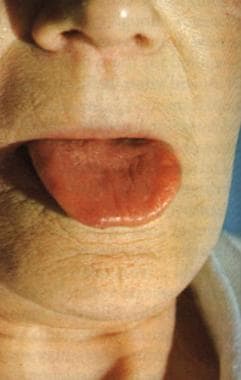 pernicious anemia tongue