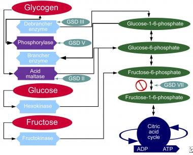 Glycogen storage disease, type II. Metabolic pathw