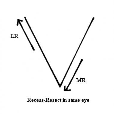 Esotropia and exotropia, V-pattern. Recess-resect 