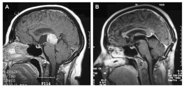 Pre and postoperative MRI from a patient with a pi