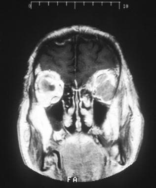 视神经鞘脑膜瘤。日冕教派