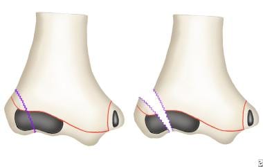 lateral condyle fx humerus closed