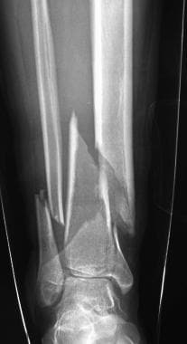 Pilon fracture showing significant comminution and