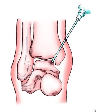 Osteochondral lesions of the talus. Illustration o