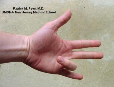 Trigger finger - Symptoms and causes - Mayo Clinic