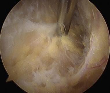 Physical Medicine and Rehabilitation for Iliotibial Band Syndrome: Practice  Essentials, Pathophysiology, Epidemiology