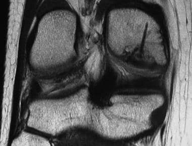 Osteochondritis dissecans. Postoperative MRI coron