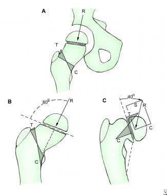 Congenital coxa vara (CCV). Hip biomechanics in co