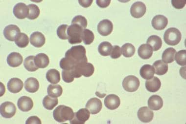 Blood smear showing spherocytic and agglutinated r