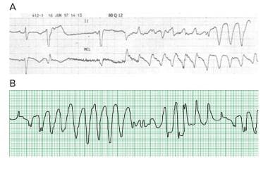 Ventricular Tachycardia Workup Approach Considerations Laboratory Studies Electrocardiography