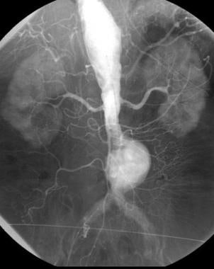 动脉造影显示肾下腹部动脉粥样硬化