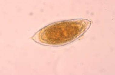 Egg of Schistosoma hematobium, with its typical te