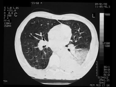 Chest CT scan in a patient with Mycobacterium kans