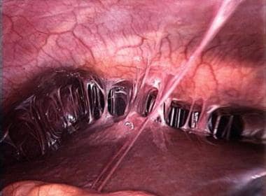 "Violin-string" adhesions of chronic Fitz-Hugh-Cur