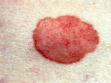 Large, superficial basal cell carcinoma. 