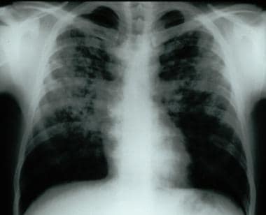 Frontal chest radiograph demonstrating bilateral r