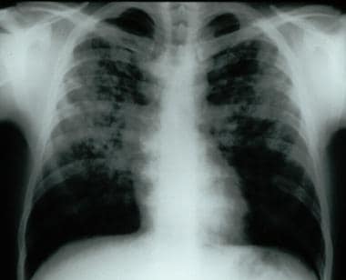 pulmonary fibrosis