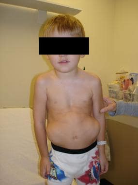 prune belly syndrome