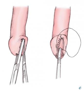 The Management of Phimosis Seen after Circumcision with