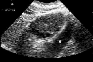 Endovaginal view of the ovary: Note its location a