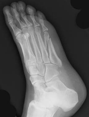 metatarsal fracture cast