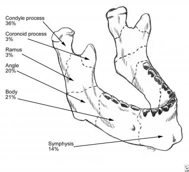 Mandibular fractures. 