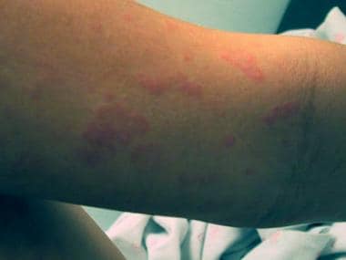 Urticarial rash in a child 10 days after cefaclor 