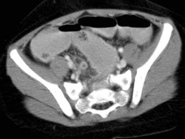CT scan revealing an enhancing tubular structure d