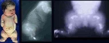 Infant with thanatophoric dysplasia. Note short-li