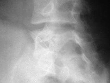 oblique view of lumbar spine