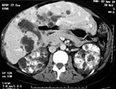 CT shows bilateral renal and liver cysts with enla