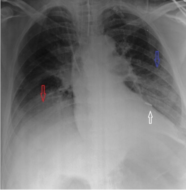 A case of misplaced nasogastric tube. Note the pos