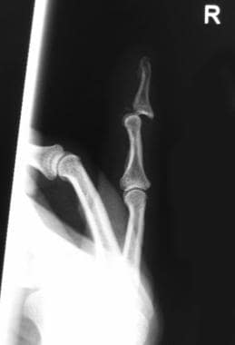 Dorsal distal interphalangeal (DIP) joint finger d