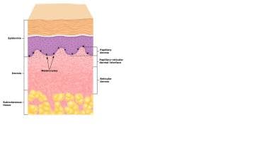 Epidermis and dermis. Courtesy of Primary Care Der