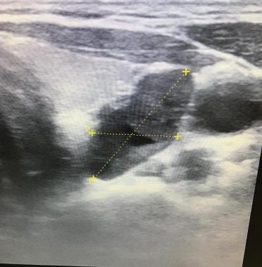 Axial ultrasound view of a 2 gram left superior pa