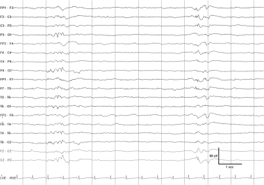 A burst-suppression pattern, a species of GPEDs, r