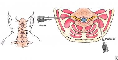 Paravertebral block technique (posterior approach)