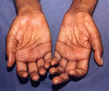 Claw-hand deformities of both hands in a patient w