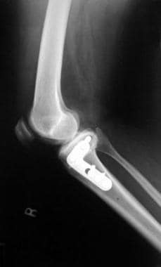 Postoperative lateral radiograph of varus knee tha