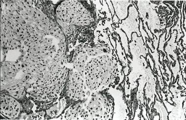 Histology showing grade 2 chondrosarcoma within lu