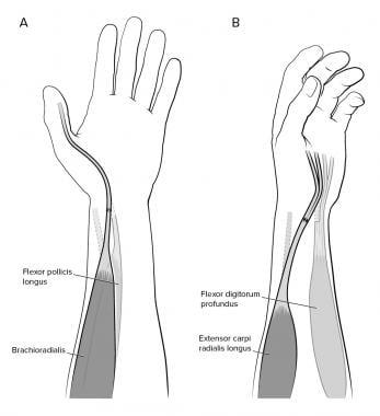 Extrinsic replacement using brachioradialis to fle
