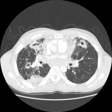 CT scan of chest of patient with chronic invasive 