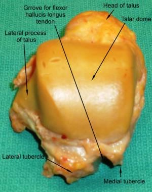 Superior surface of the talus bone. 