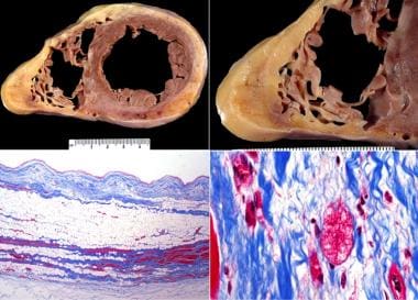 restrictive cardiomyopathy histology