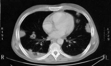 CT scan of aspergillosis of the lungs showing mult