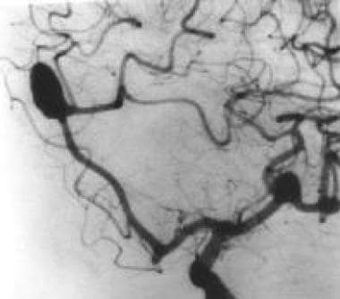 Left oblique cerebral angiogram in a patient with 