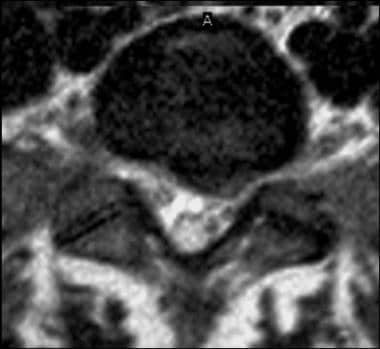 Axial T2-weighted image shows protraction of a lef
