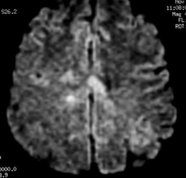 Axial diffusion-weighted MRI in a patient with mul