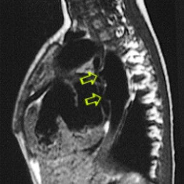 Sagittal T1-weighted MRI of the chest in a patient